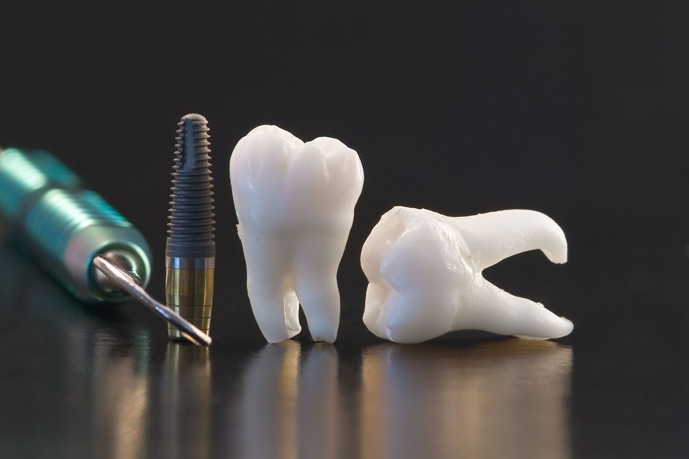 インプラント治療とは